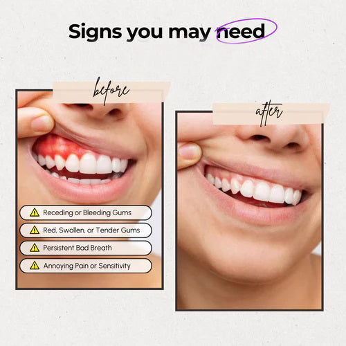 Red Light Therapy For Gums